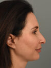 Rhinoplasty case #11719