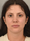 Deep Neck Contouring case #11329