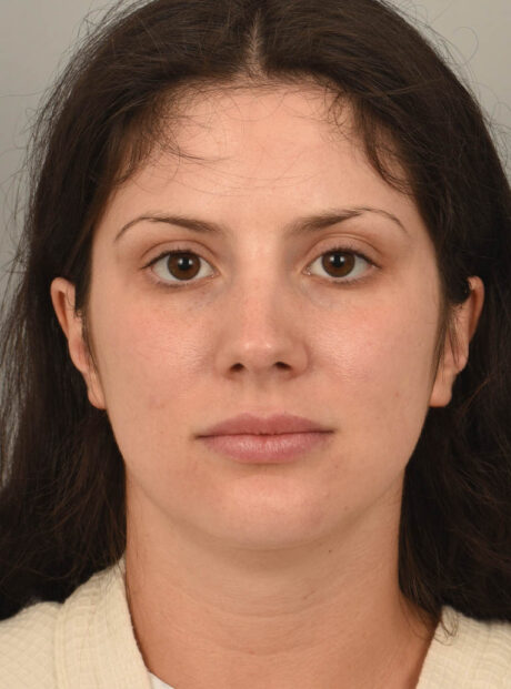 Deep Neck Contouring case #11329