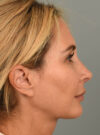 Rhinoplasty case #11719