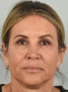Eyelid Surgery case #11799