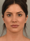 Deep Neck Contouring case #11329