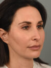 Rhinoplasty case #11719