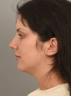 Deep Neck Contouring case #11329