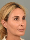 Rhinoplasty case #11719