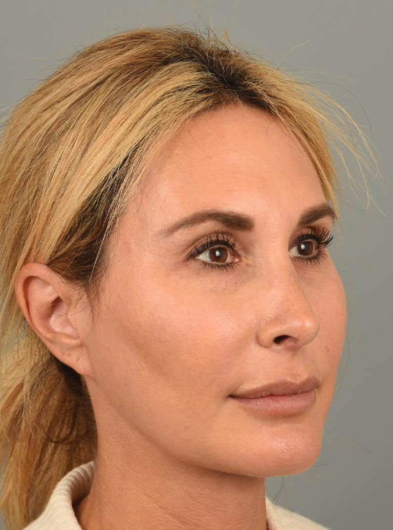 Rhinoplasty case #11719