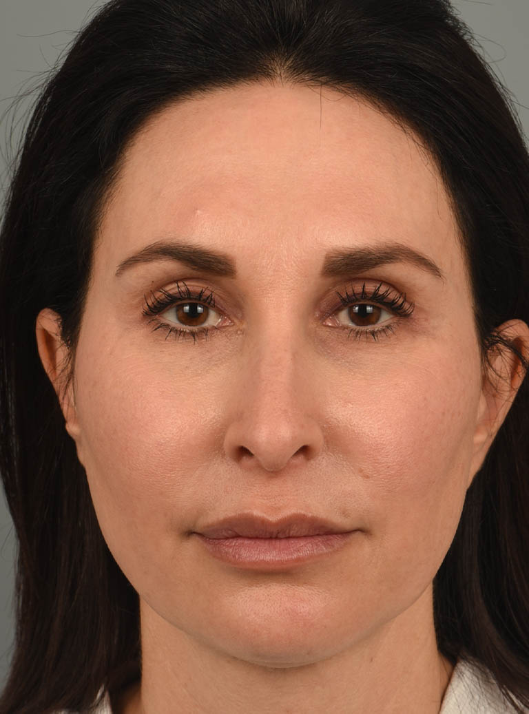 Rhinoplasty case #11719