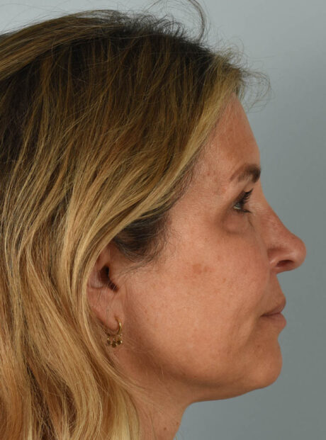 Eyelid Surgery case #11799