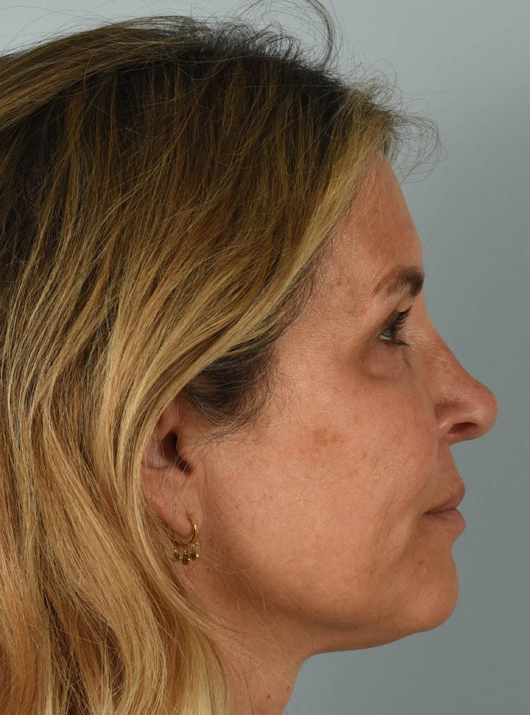 Eyelid Surgery case #11799