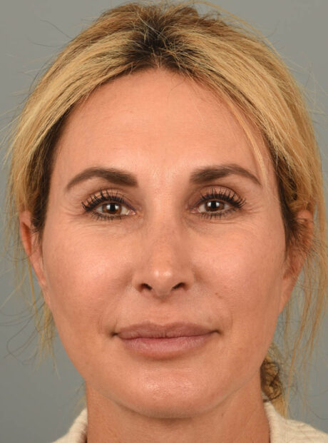 Rhinoplasty case #11719