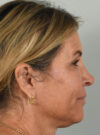 Eyelid Surgery case #11799
