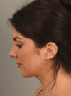 Deep Neck Contouring case #11329
