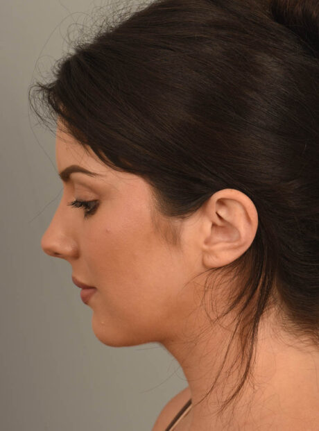 Deep Neck Contouring case #11329