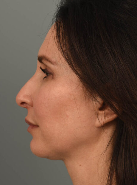 Rhinoplasty case #11719