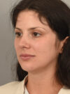 Deep Neck Contouring case #11329