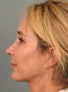 Rhinoplasty case #11719