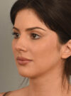 Deep Neck Contouring case #11329
