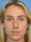 Rhinoplasty case #11711
