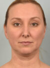 Deep Neck Contouring case #11320