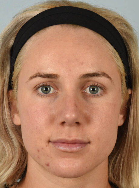 Rhinoplasty case #11711