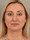 Deep Neck Contouring case #11320