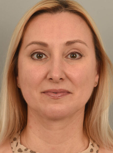 Deep Neck Contouring case #11320