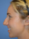 Rhinoplasty case #11711