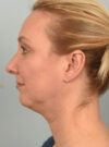 Deep Neck Contouring case #11320