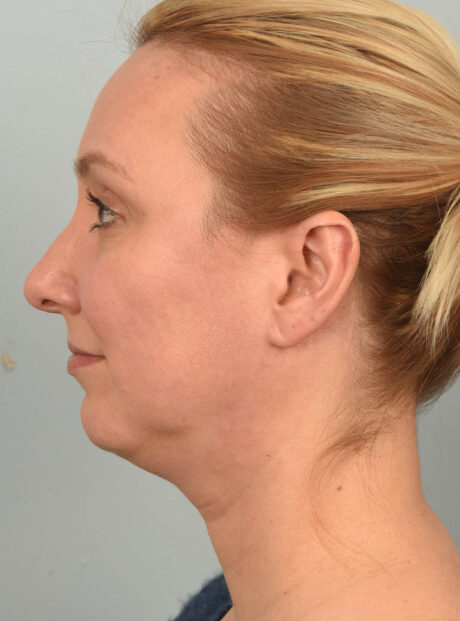 Deep Neck Contouring case #11320