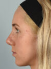 Rhinoplasty case #11711