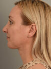 Deep Neck Contouring case #11320
