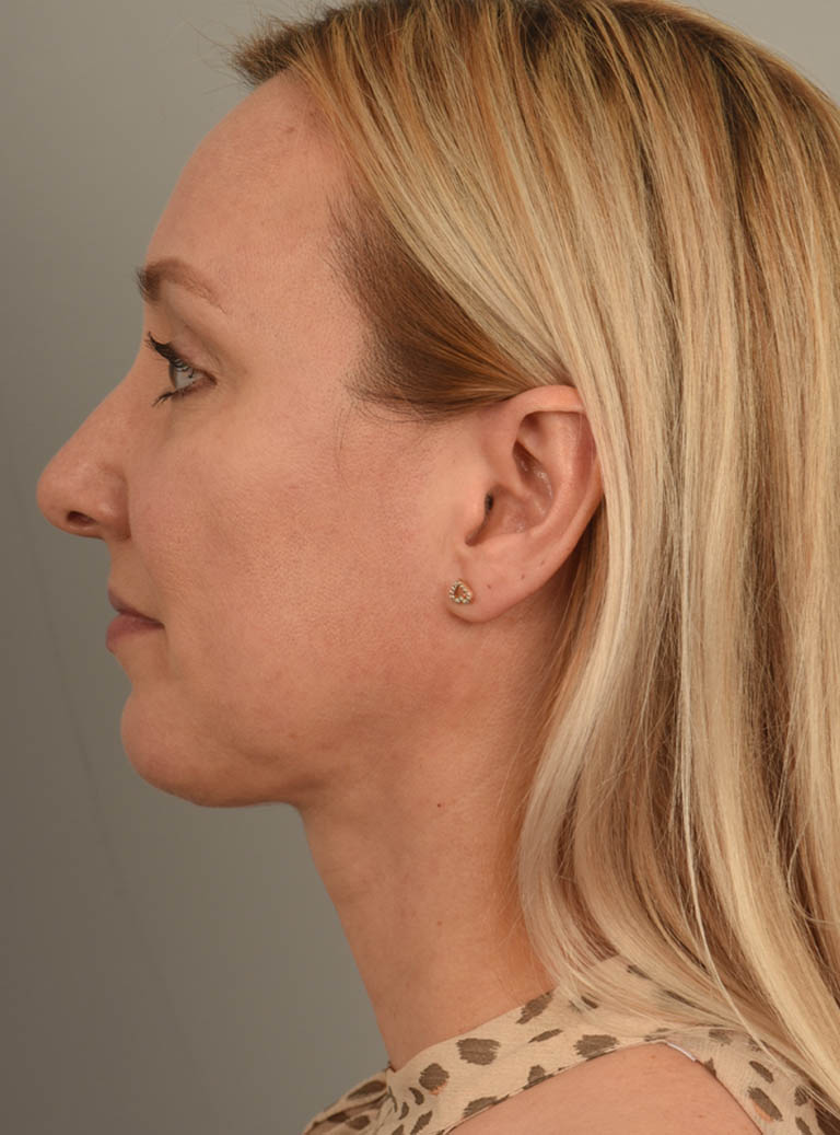 Deep Neck Contouring case #11320
