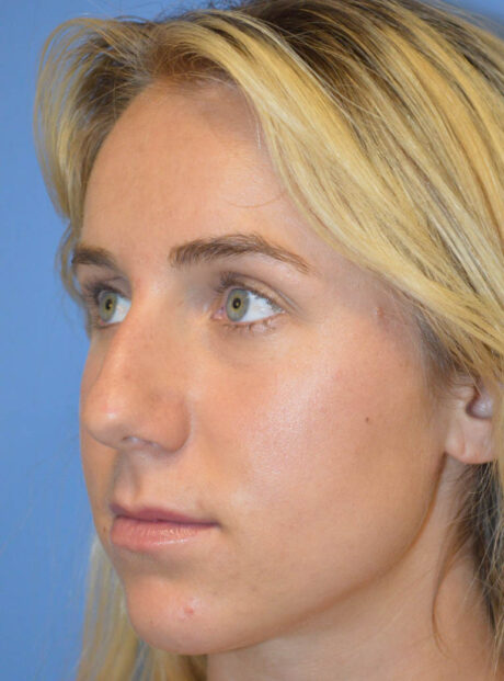 Rhinoplasty case #11711