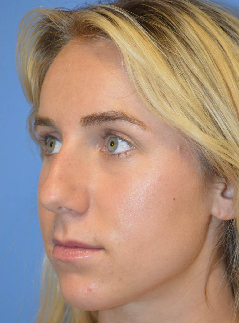 Rhinoplasty case #11711
