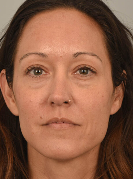 Eyelid Surgery case #11802