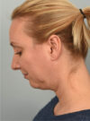 Deep Neck Contouring case #11320