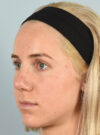 Rhinoplasty case #11711