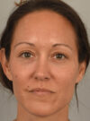 Eyelid Surgery case #11802