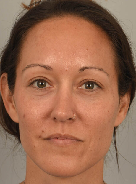 Eyelid Surgery case #11802