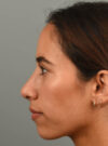 Rhinoplasty case #11722