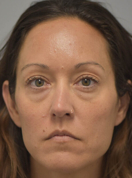 Eyelid Surgery case #11802