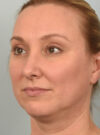 Deep Neck Contouring case #11320