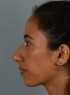 Rhinoplasty case #11722