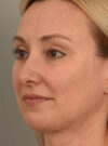 Deep Neck Contouring case #11320