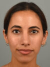 Rhinoplasty case #11722