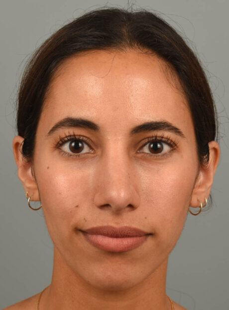 Rhinoplasty case #11722