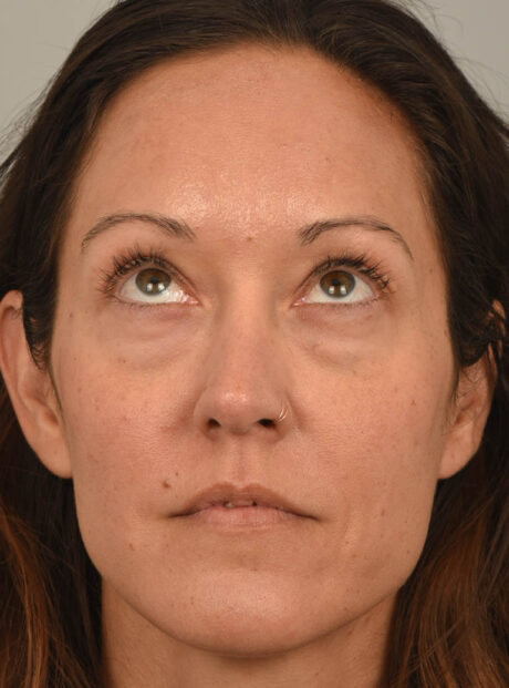Eyelid Surgery case #11802
