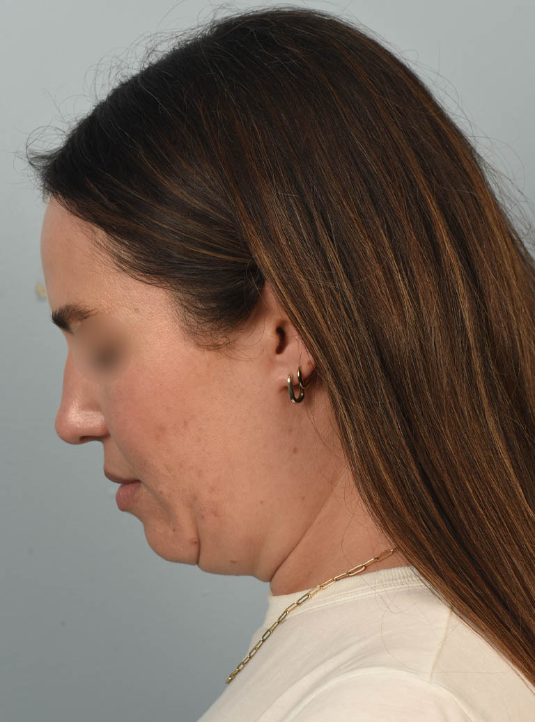 Deep Neck Contouring case #11347