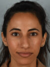 Rhinoplasty case #11722