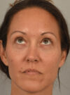 Eyelid Surgery case #11802